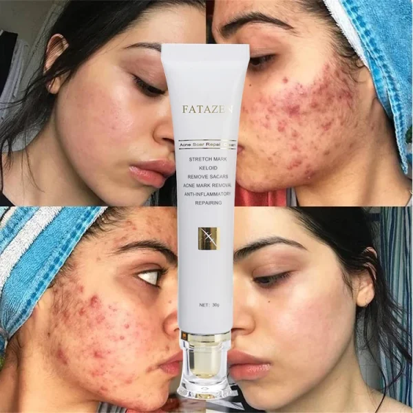 FATAZEN Private Label Organic Natural Herbal Skin Repairing Cream Pregnancy Stretch Mark Pimple Repair Acne Scar Removal Cream - Image 2