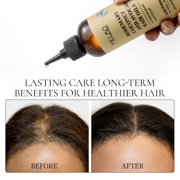 Rosemary Essential Hair Loss Oil Growth Oil Hair Strengthening Dandruff Itchy Deep Rosemary Coconut Avocado Hair Oil - Image 5