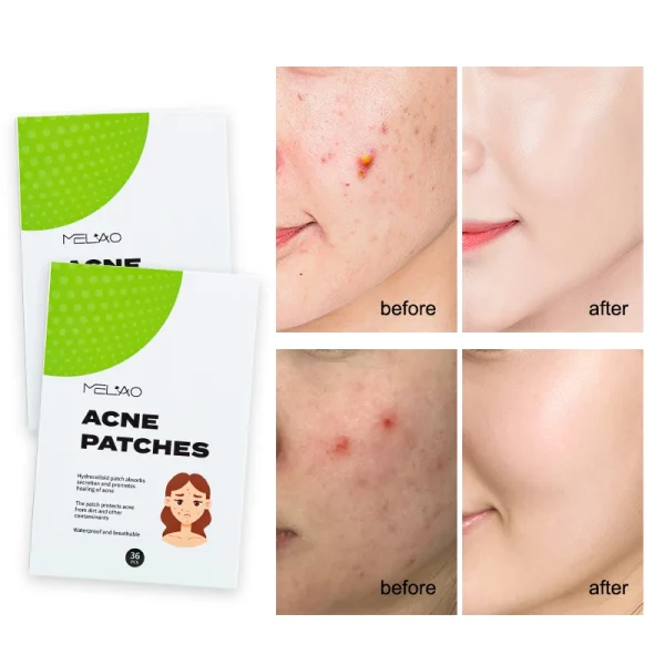 Day and Night Acne Pimple Patches for Face Invisible Spot Patches Covering and Blemishes with Tea Tree Salicylic Acid 30 Patches - Image 2