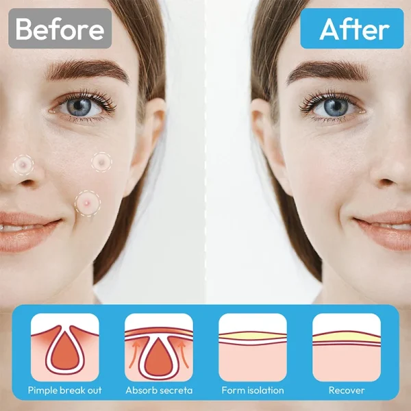 Day and Night Acne Pimple Patches for Face Invisible Spot Patches Covering and Blemishes with Tea Tree Salicylic Acid 30 Patches - Image 5